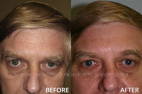 Before And After Facial Plastic Surgery Center Washington