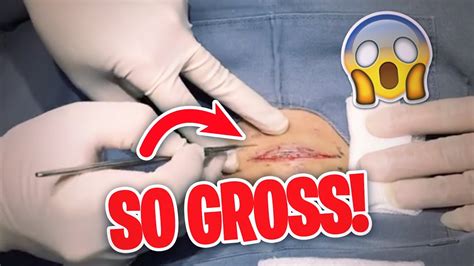 The Grossest And Most Disgusting Moments On Dr Pimple Popper 🤢 Youtube