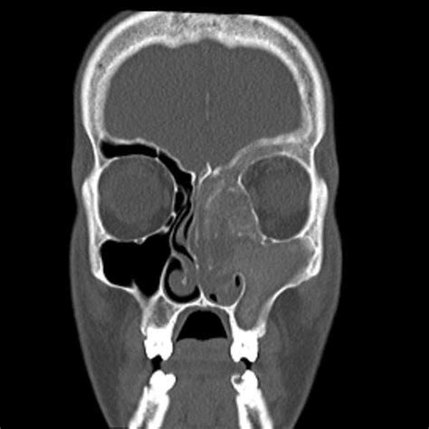 Double Density Sign In Fungal Sinusitis Filled With Allergic Mucin