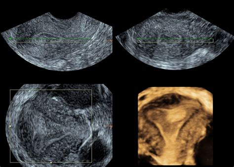 The Role Of Three Dimensional Ultrasound In Gynecology Scitemed