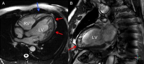 End Diastolic Cardiac Magnetic Resonance Representative Images From An