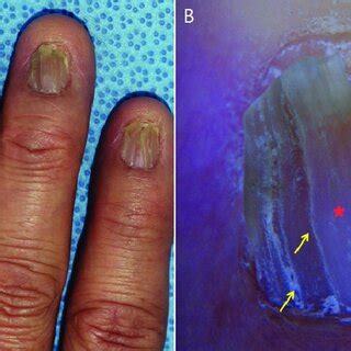 Nail Lichen Planus A Clinical Photograph Of Nail Lichen Planus With