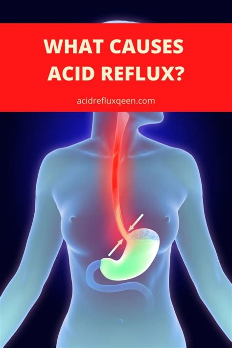 What Causes Acid Reflux Simply Noel