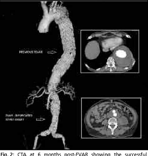 Figure From Ruptured Abdominal Aortic Aneurysm Treated By