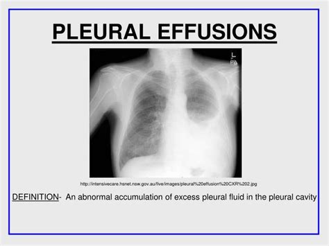 Ppt Pleural Effusions Powerpoint Presentation Free Download Id 1999648