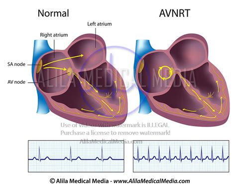 Alila Medical Media | AVNRT labeled | Medical illustration