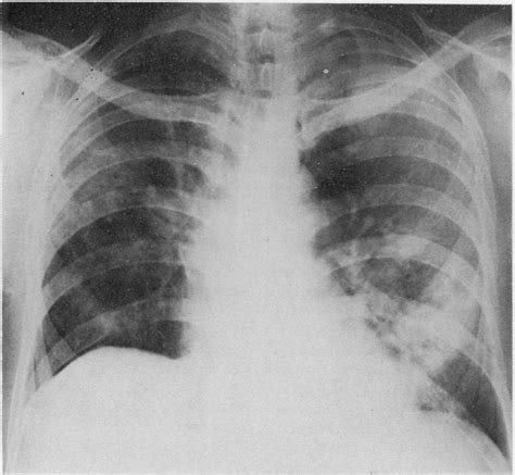 Case Postero Anterior Chest Radiograph Showing An Alveolar Filling