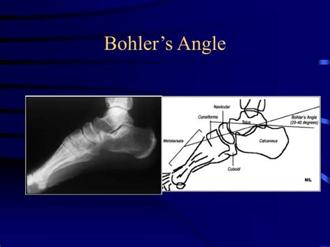 PPT - Radiology of the Foot PowerPoint Presentation - ID:430607