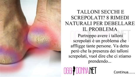 Talloni Secchi E Screpolati Rimedi Naturali Per Debellare Il