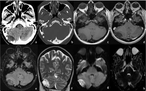 [pdf] Dermoid Cysts Of The Asterion An Unusual Location For Unusual