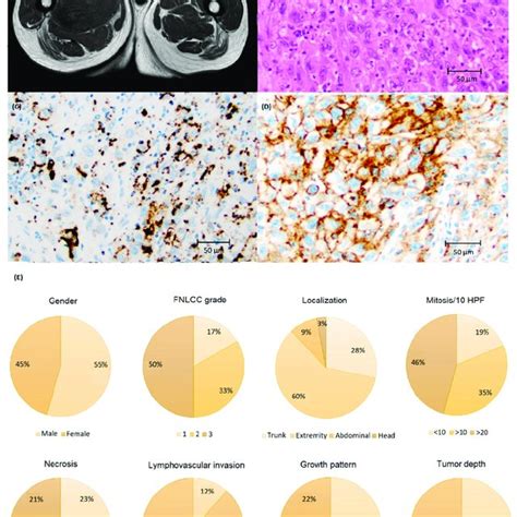 A Magnetic Resonance Imaging Of Undifferentiated Pleomorphic Sarcoma