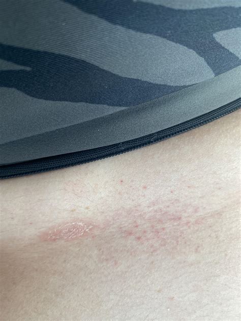 Lamictal rash? : r/lamictal