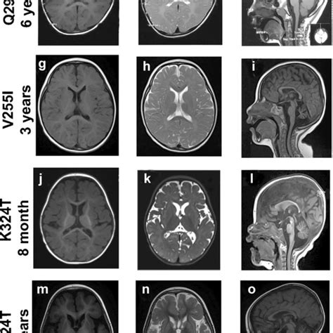 Brain MRI features of patients. Axial T1 (a–g)- and T2 (b–h)-weighted ...