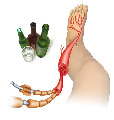 What is Alcoholic Neuropathy? - Healthier Steps