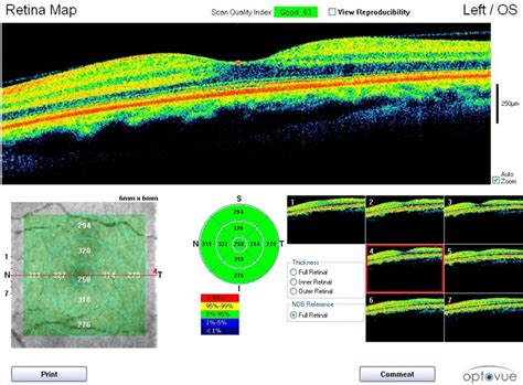 Understanding Causes Of Macular Degeneration RSF Optometry