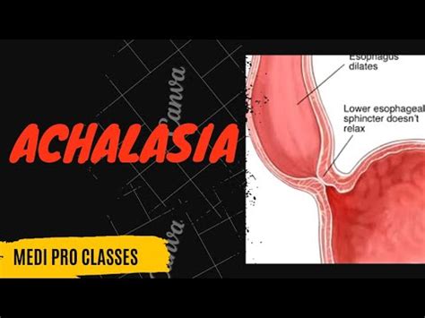 Achalasia Etiology Pathophysiology Diagnosis Management DoctorNajeeb