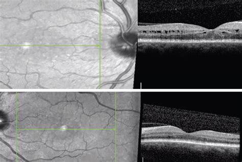 Mild Cystoid Macular Edema