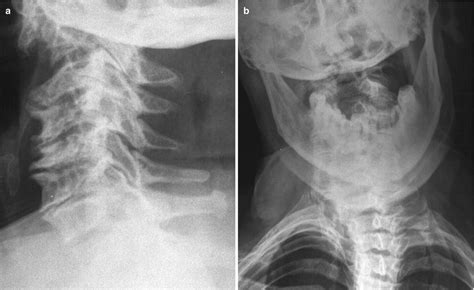 Atlanto Occipital Joint Xray