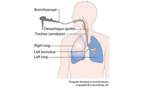 Bronchoscopy - European Lung Foundation