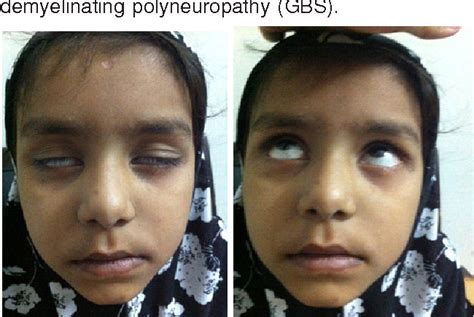 Bilateral Facial Nerve Palsy