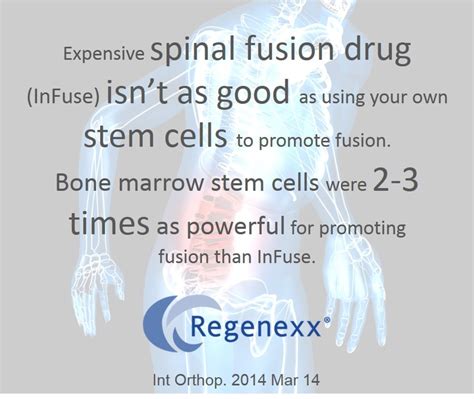 Spinal Fusion Recovery Plan? Use Your Own Bone and Stem Cells Over ...