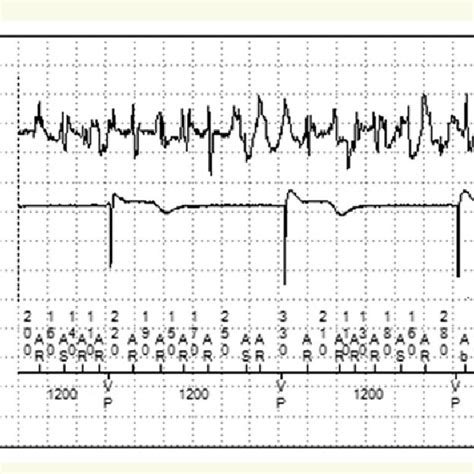 Typical Intracardiac Electrogram Retrieved From A Patient With Atrial Download Scientific