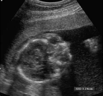 Gestational Age Ultrasound Dating – Telegraph