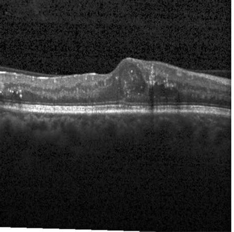 Visualization result of an OCT slice with DME. | Download Scientific ...