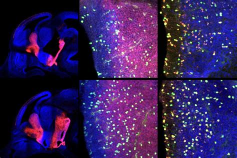 What’s next for brain-directed gene therapy after death in Neurogene ...