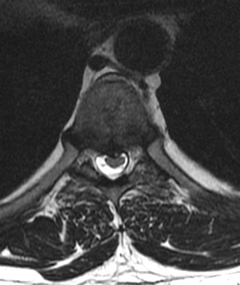 T7 T8 Disc Protrusion Image Radiopaedia Org