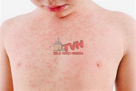 Salute Allarme Morbillo Scoppia Lepidemia In Sicilia Televideo Himera