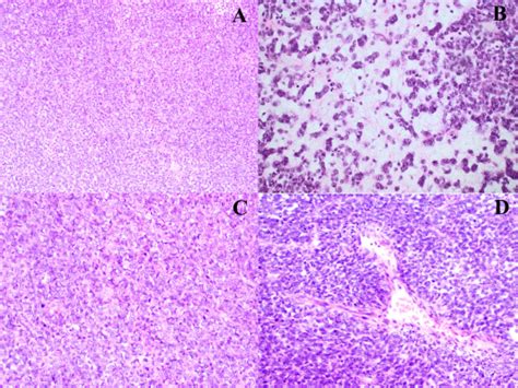 A Challenging Case Of A Poorly Differentiated Small Cell Variant Of