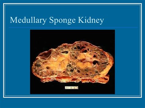 Non Glomerular Disease Renal Disease Nephropathy Medullary Sponge