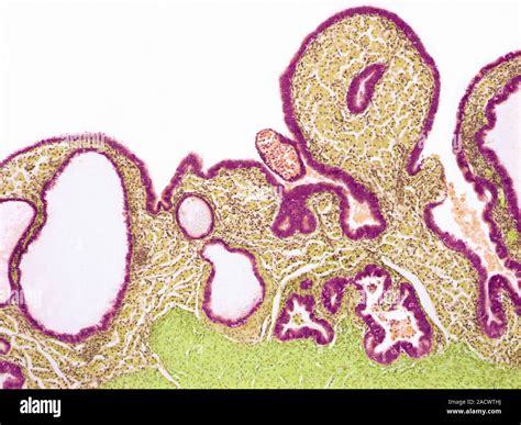 Inflamed Fallopian Tube Light Micrograph Of A Section Through A