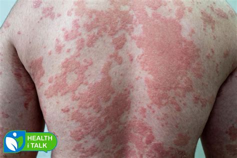 Is Psoriasis Contagious