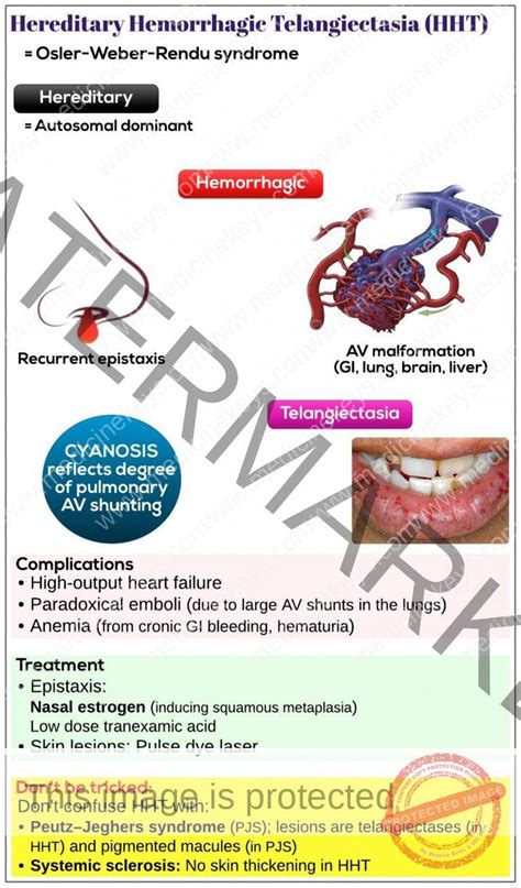 Hereditary Hemorrhagic Telangiectasia HHT Medicine Keys For MRCPs