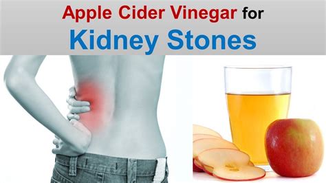 Apple Cider Vinegar For Kidney Stones Remove Kidney Stones With Acv