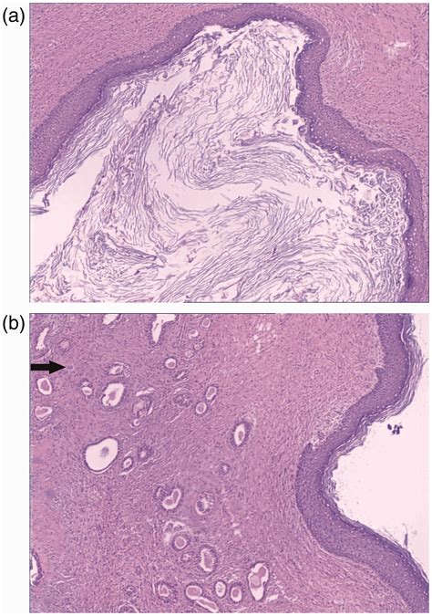 Epidermal Inclusion Cyst Histology