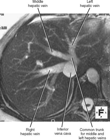 Liver Anatomy Radiology