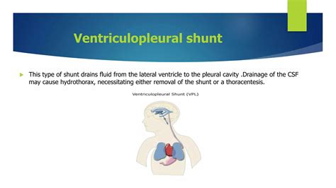 Hydrocephalus Spina Bifida And Craniosynotosis Ppt