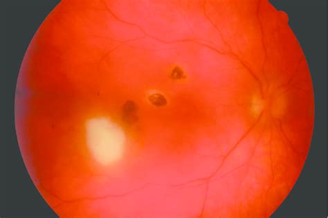 Recurrent Toxoplasma Retinochoroiditis A Satellite Lesion Associated