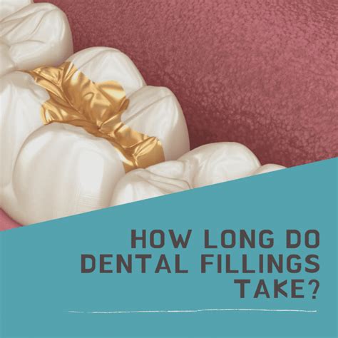 How Long Do Dental Fillings Take