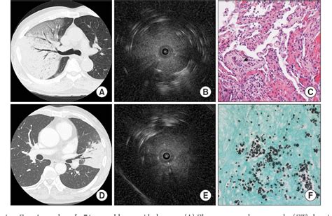 Figure 1 From Utility Of Radial Probe Endobronchial Ultrasound Guided