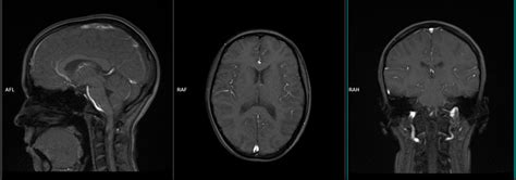 Cerebrospinal Fluid Flow Mri Csf Flow Mri Protocol And Planning