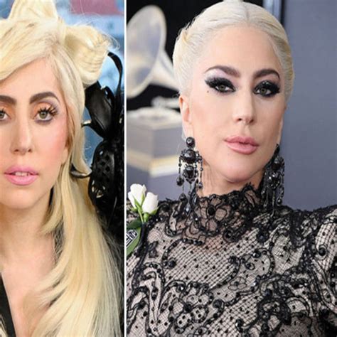 Lady Gaga Nose Job Before After