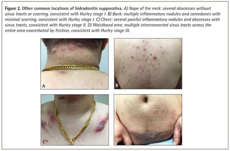 Hidradenitis Suppurativa Back