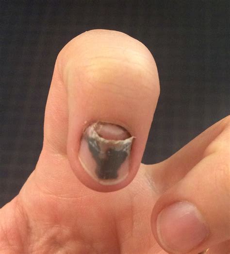 I smashed my finger with a rock hammer 6 weeks ago. The old nail is ...