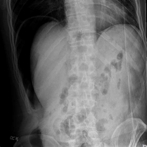 Intestinal Perforation Pneumoperitoneum Undergraduate Diagnostic