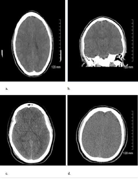 Anoxic brain injury CT and MRI patterns - quick pictoral quide for junior radiologists ...