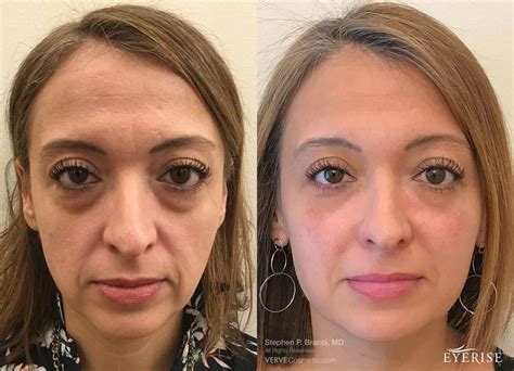 Mastering The Botox Lip Flip Injection Techniques Precision And Aesthetics Blog